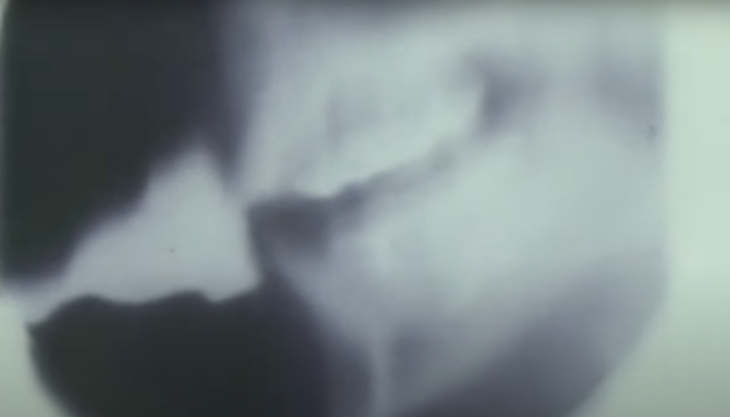 Video Fluoroscopy of The Tongue During Trumpet Playing